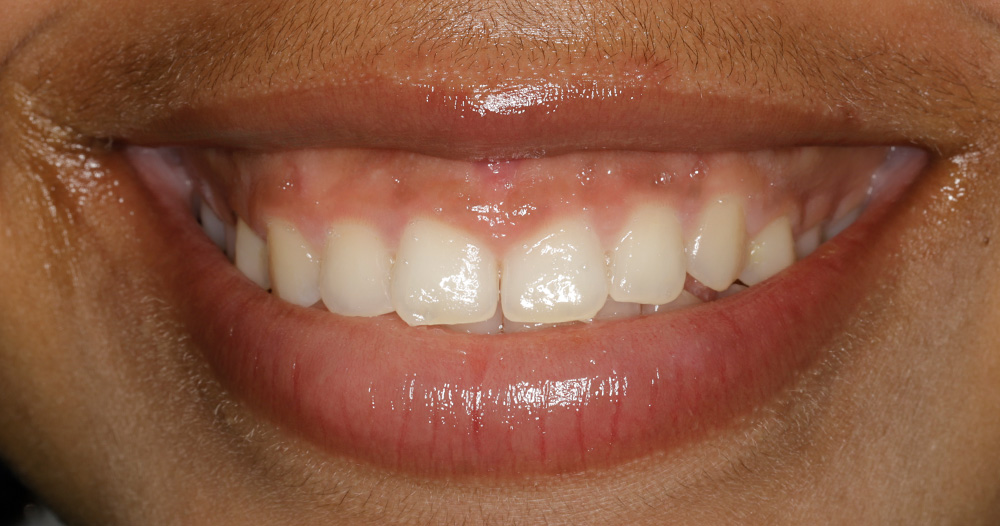 Soft Tissue Gum Graft Before & After Periodontist NYC