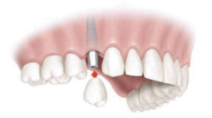 Dental Implant Problems