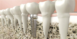 Dental Implant Pros and Cons