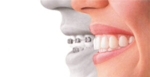 Dental Implants Instead of Braces