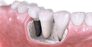 Dental Implants Replacing Single or Multiple