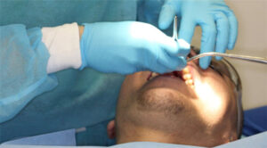Guided Tissue Regeneration