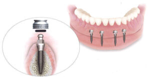 Implants Instead of Dentures