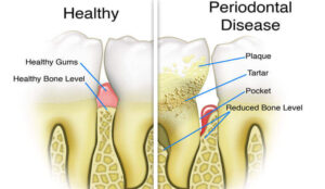 Periodontal Gum Pockets