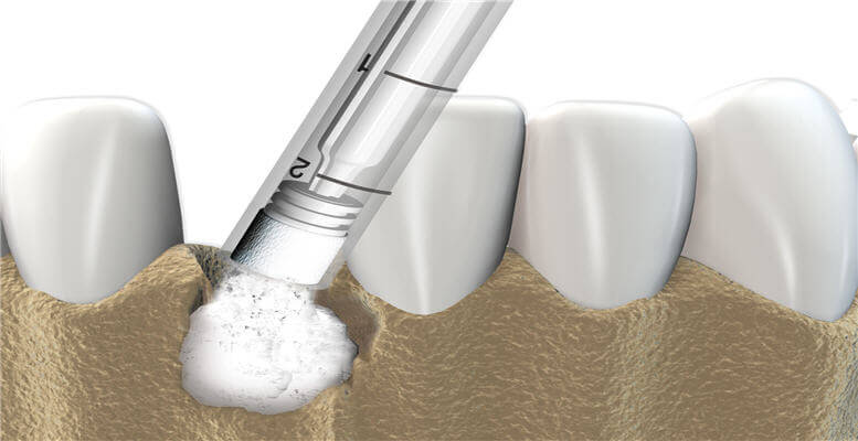 Ridge Augmentation