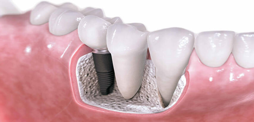 Dental Implants Same Day SmileIs Reality