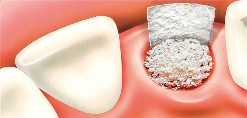 Bone Grafting NYC | Why Bone Grafts are Needed ?