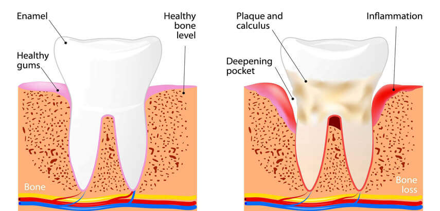 Learn About Periodontal Disease Treatment in Manhattan NYC