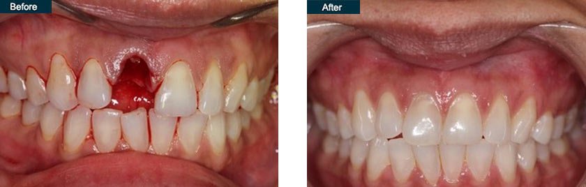 Dental Implant Procedure nyc