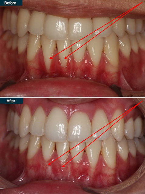 Gum disease