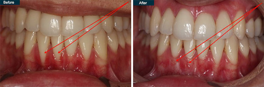 Periodontal Gum Disease Treatment New York Periodontist