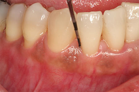 Periodontal Gum Pocket Treatment NYC