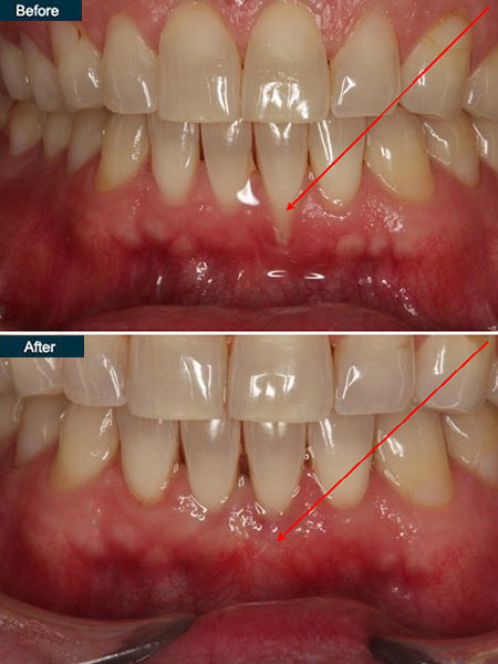 Types Of Gum Surgery