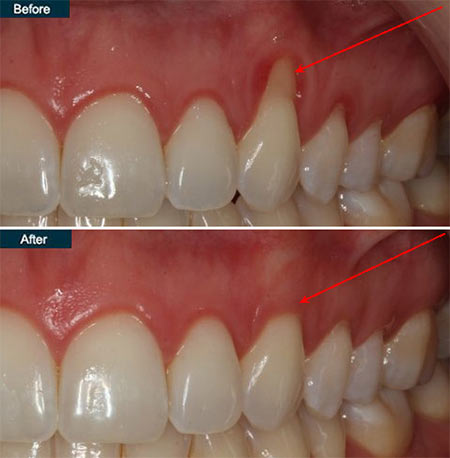 Receding Gums Treatment | periodontist NYC Dr. Rahmani