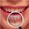 All about Dental Implants in New York City