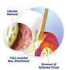Laser Periodontics in New York City