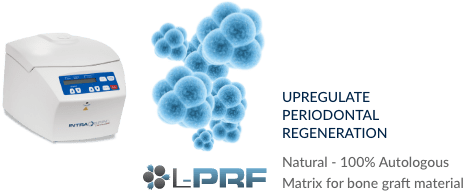LPRF - Periodontal regeneration