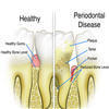 What is gingivitis?