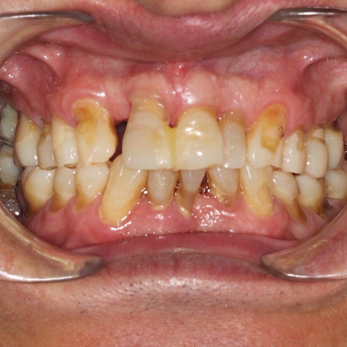 What Is a Gum Graft #1