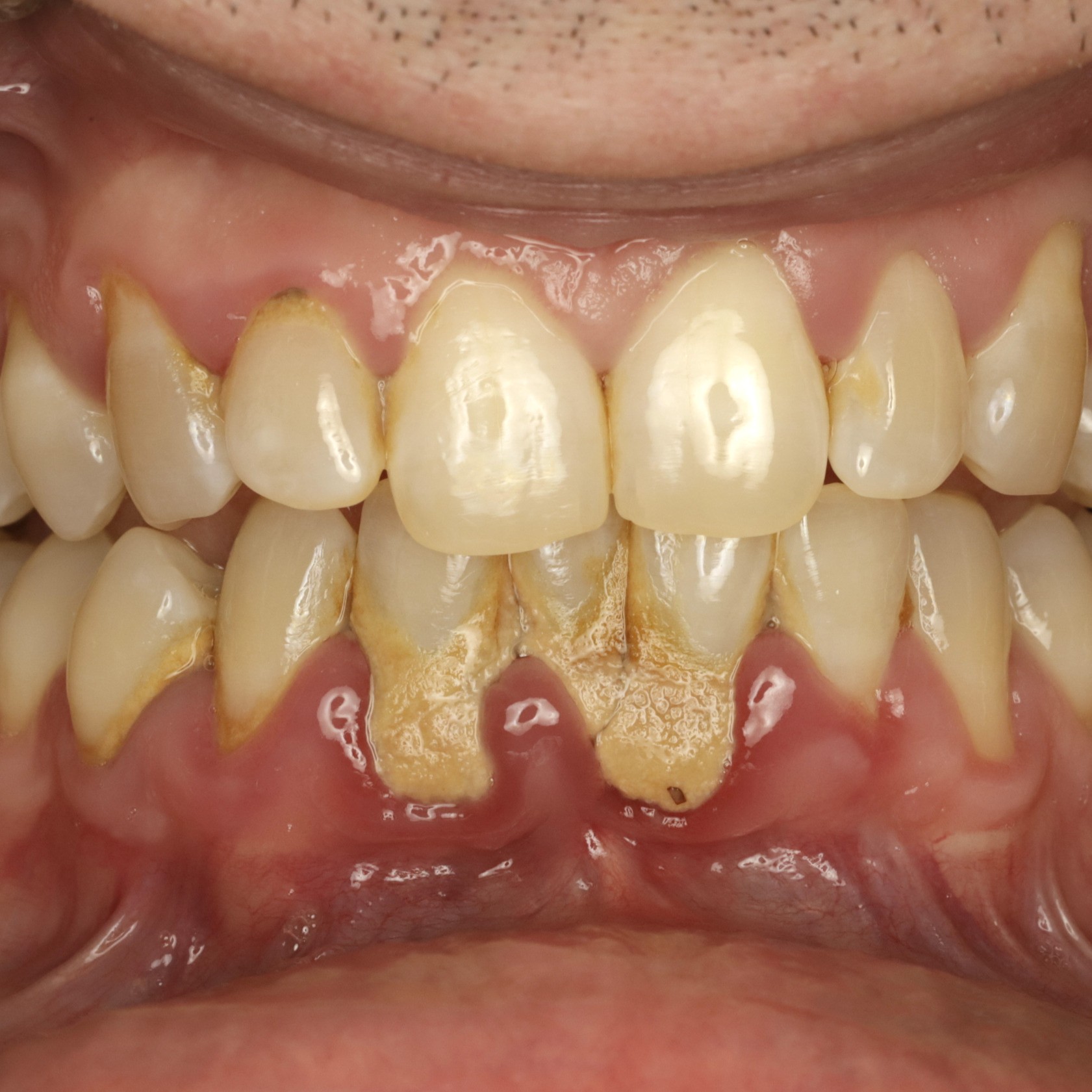 What Is a Gum Graft #2