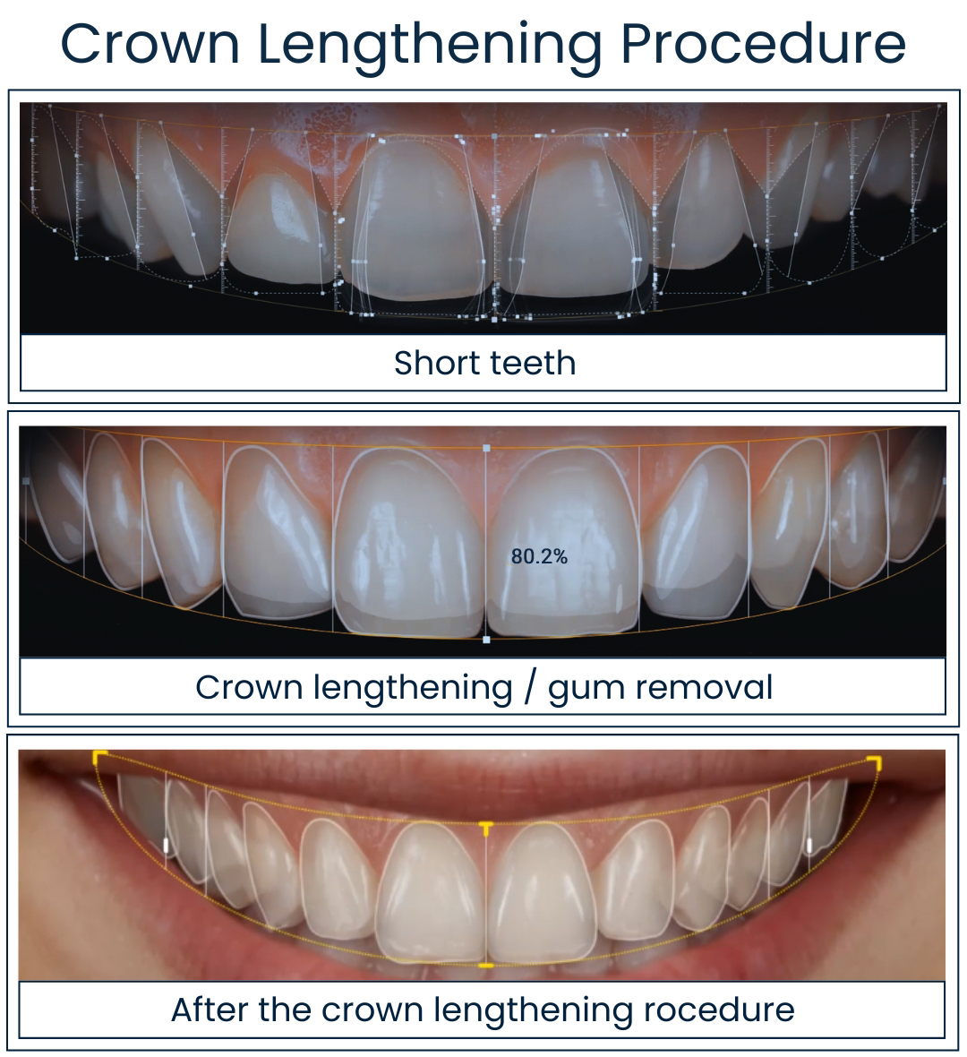 Crown Lengthening Procedure