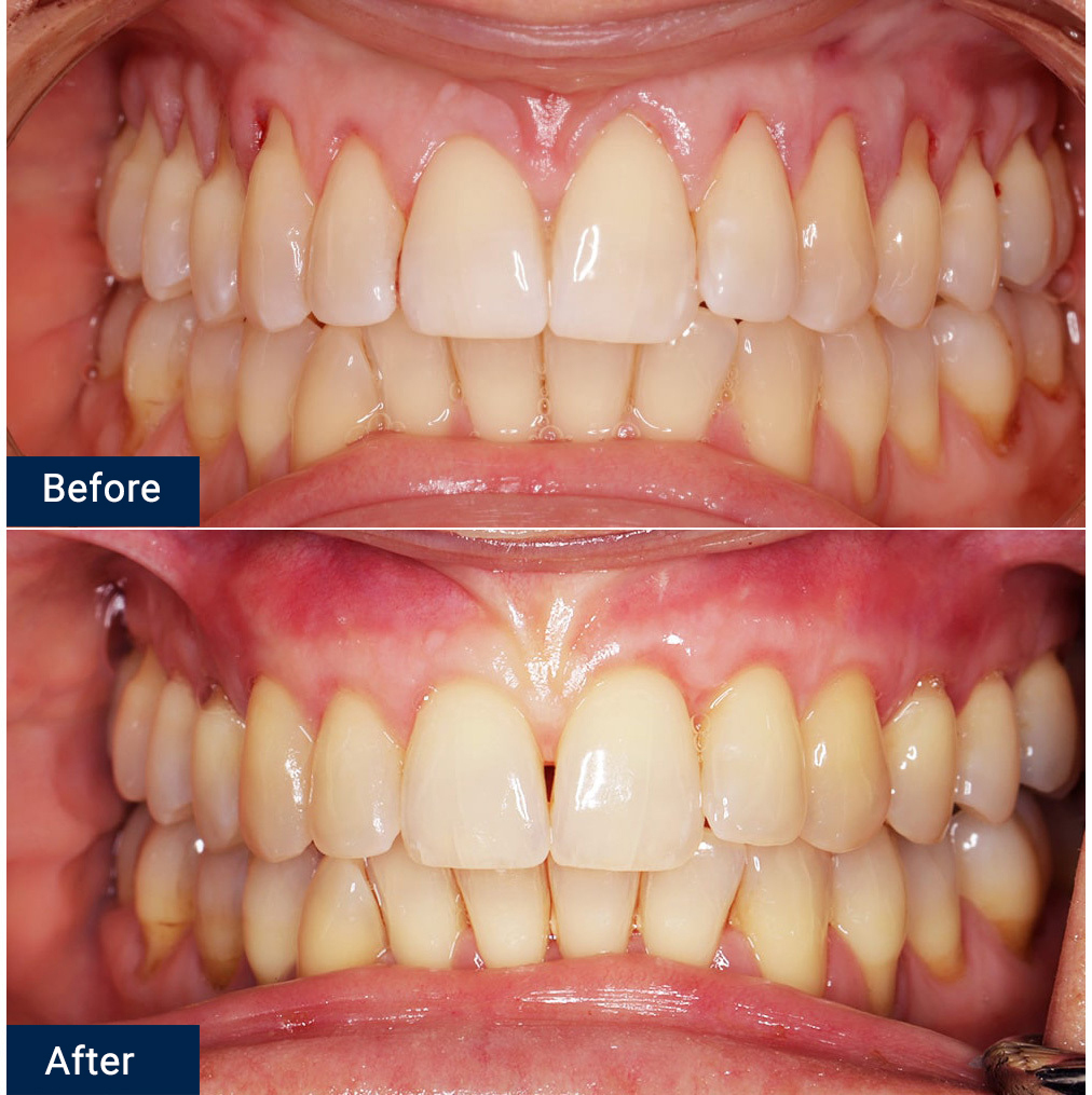 Gum Grafting NYC | Gum Surgery - New York Periodontist | Dr. Rahmani
